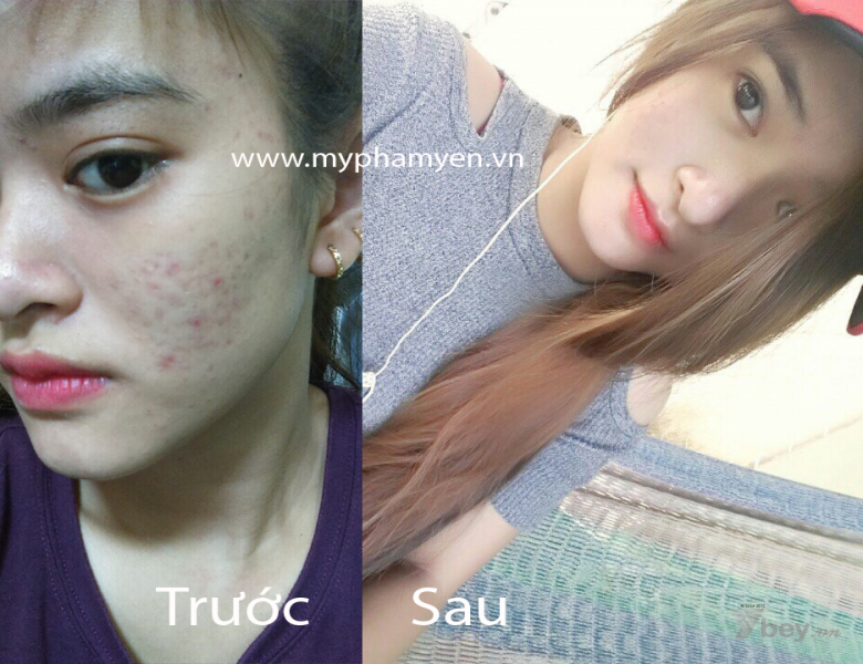 Da mình bớt mụn đi nhiều, sáng hẳn lên chỉ sau 2 tuần sử dụng phương pháp này