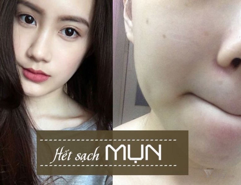 Nguyên nhân và 06 cách trị mụn cám tại nhà hiệu quả